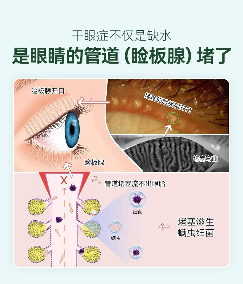 e doctor茶树油湿巾给干眼症患者带来福音麻将胡了网址皇室御用品牌英国眼博士the ey(图1)